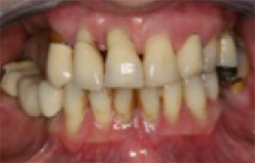 Image 4. Failing dentition  due to gum disease