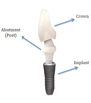 Dental implant