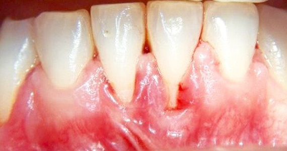 gums receding