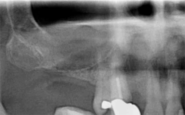 Image 1. Preoperative x-ray (large maxillary sinus)