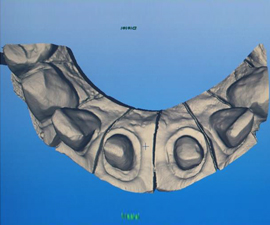 3D Scan Dental Model