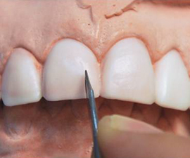 Diagnostic wax up of final restorations