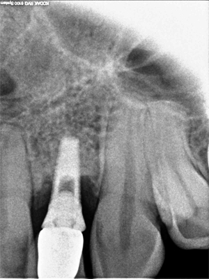 Image 4. Referred failed dental implant to Dr Madruga