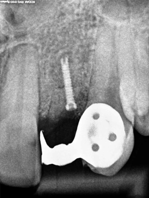 Image 5. Autogenous block bone graft(mandibular ramus)