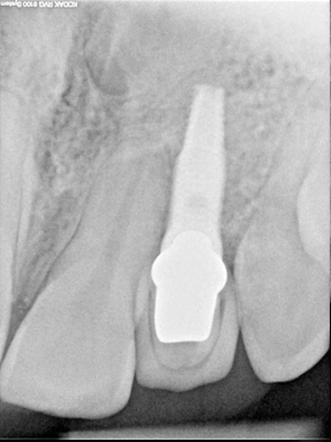 Image 6. Final dental implant supported- crown (4 months after bone graft)