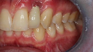 Image 4. Referred failed dental implant to Dr Madruga