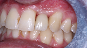 Image 5. Autogenous block bone graft(mandibular ramus)