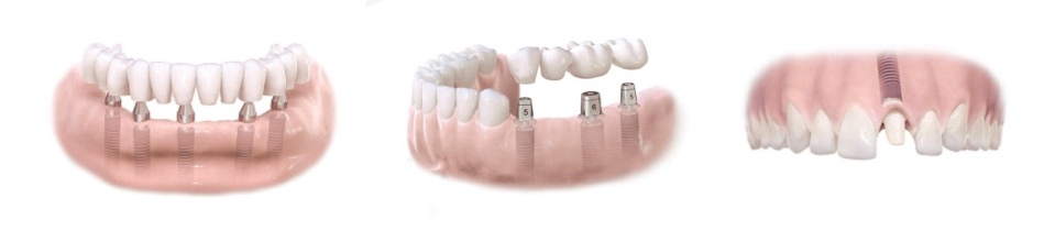 dental implants