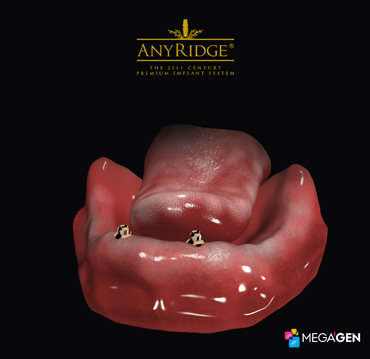 Image 2. Placement of two dental implants