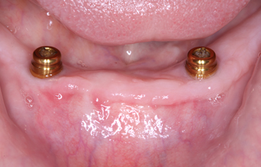 Image 5. Placement of two dental implant fixtures