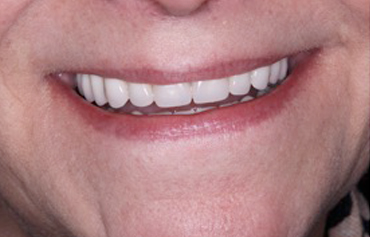 Image 6. Implant retained dentures