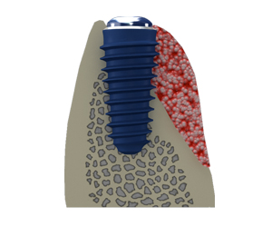 Image 2. Placement of a bone substitute material