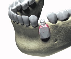 Image 3. Guided tissue regeneration