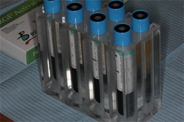 Image 1. Blood fractions after centrifugation cycle