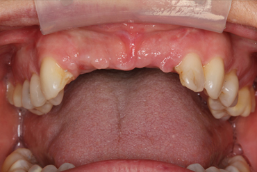 Image 3. Multiple missing teeth/bone loss