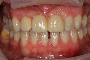 Image 4. Final  result after bone augmentation/PRGF