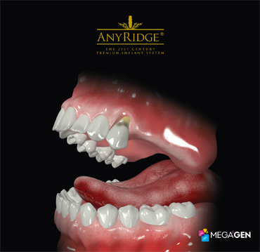 Image 1. Multiple  teeth missing
