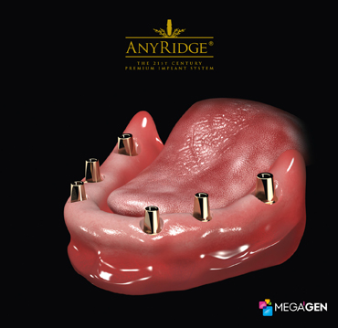 Placement of multiple  dental implants