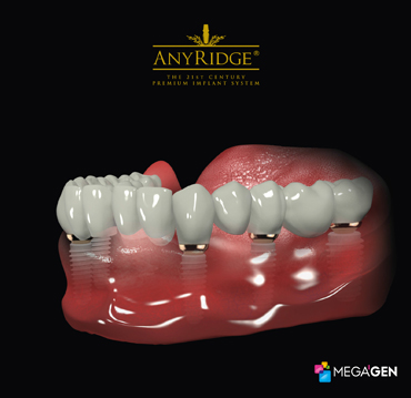 Full arch rehabilitation with multiple  dental implants