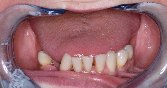 All upper teeth missing, lower teeth failing (gum disease)