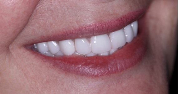 Full mouth rehabilitation using dental implants