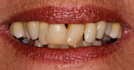 Image 1. Failing teeth due to gum  disease