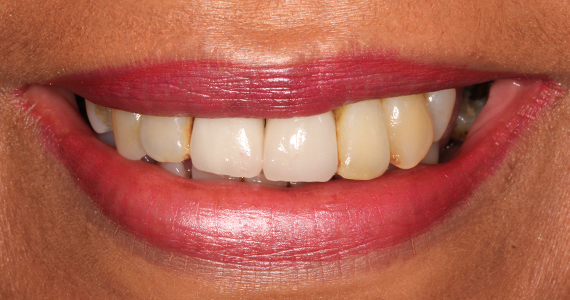 Image 3. Failing teeth due to gum disease