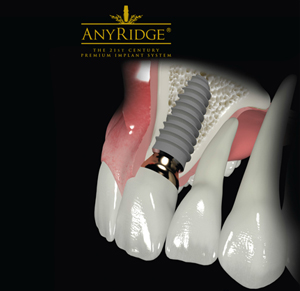 Image 2. Implant tooth crown