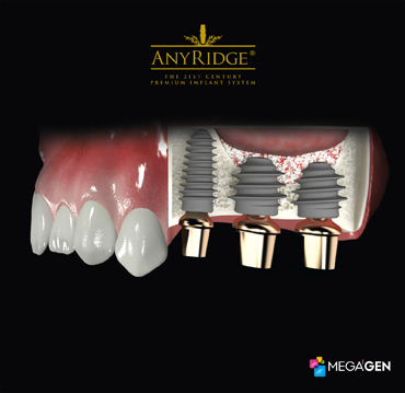 Image 2. Dental implants placed into bone graft