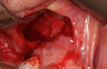 Image 4. Sinus lining lifted