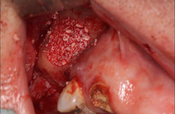 Image 5. Bone graft material placed