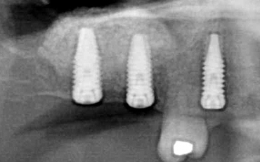 Image 2. Postoperative x-ray after sinus lift/implant placement