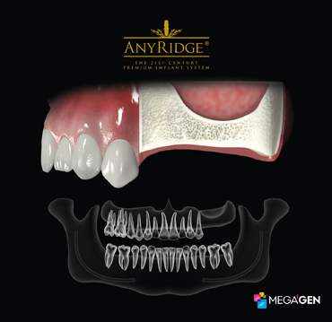 Image 1. Posterior maxilla, large maxillary sinus