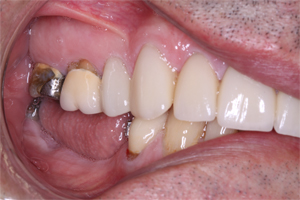 Image 4.Three teeth missing