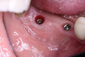 Image 5. Placement of two dental implants