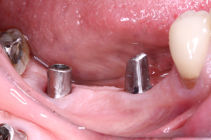 Image 6. Final abutments (posts)